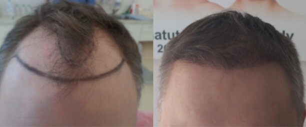 Трансплантацию волос проводят в клинике Rubenhair. Трансплантацию волос проводят в клинике Rubenhair.